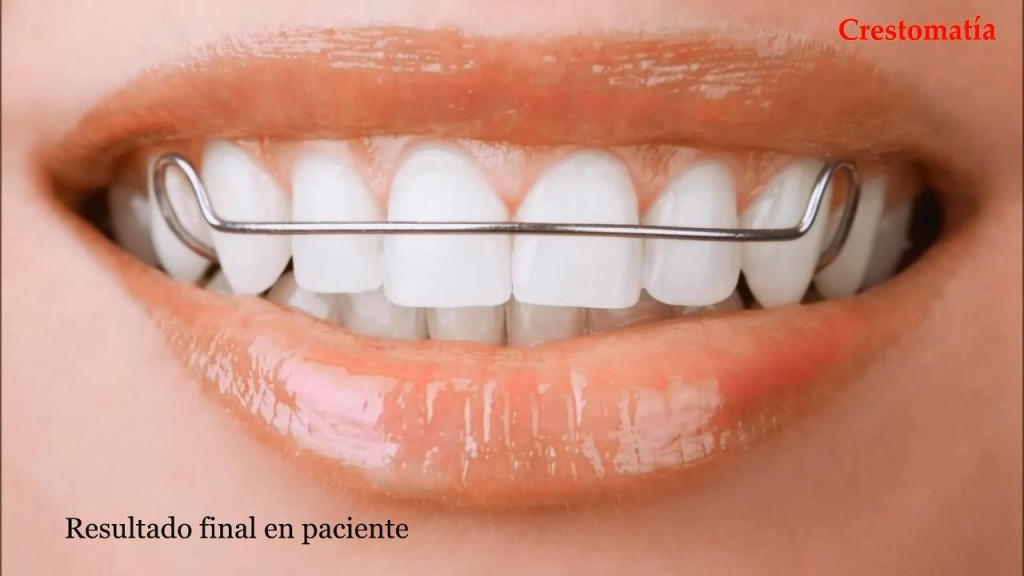 Guía práctica: Cómo limpiar retenedores dentales de forma efectiva