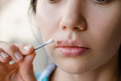 Guía definitiva: cómo limpiar herpes labial rápidamente