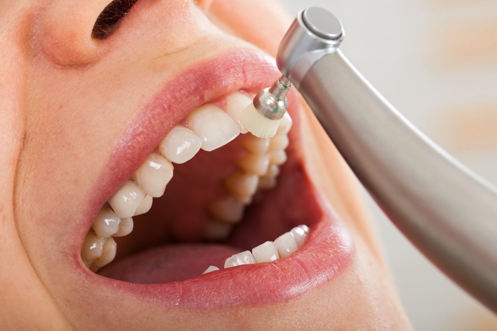 Limpiador dental: la solución para una sonrisa perfecta